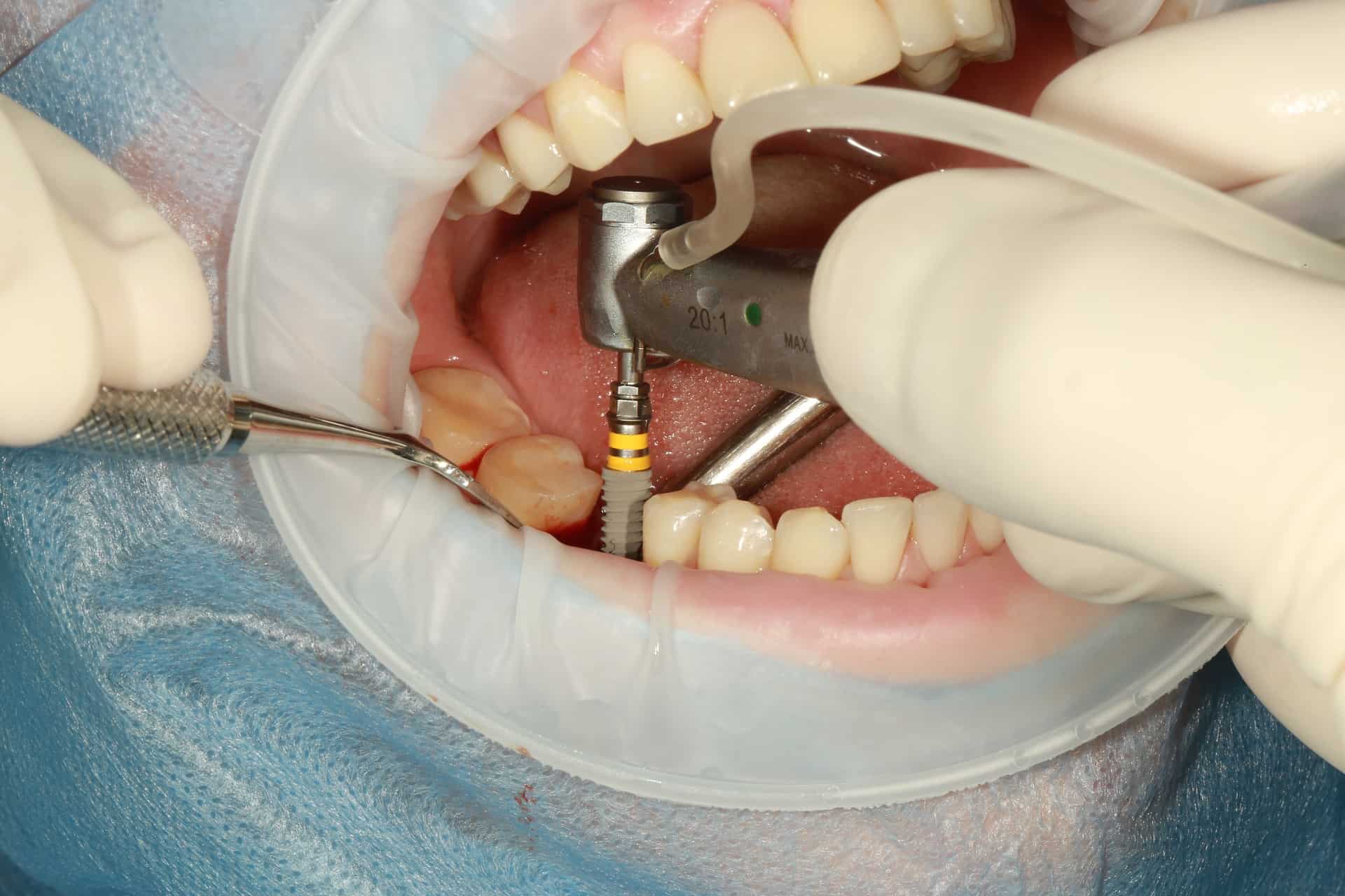 4 Pros And Cons Of Dental Implants Are They Right For You